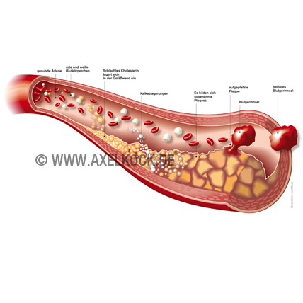 Arteriosklerose