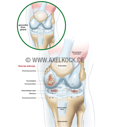 Kniegelenk-Arthrose