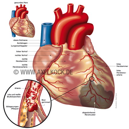 Herzinfarkt