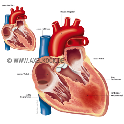 Herzschwäche