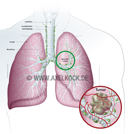 Lungenkrebs