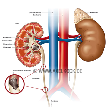 Nierensteine