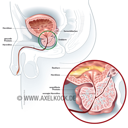 Prostataerweiterung