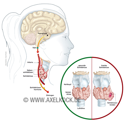Schilddrüsenerkrankung