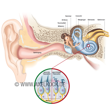 Tinnitus