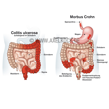Darmerkrankungen