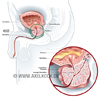 Prostataerweiterung